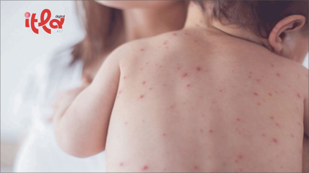 Measles Outbreak Out of Control in Sindh: 53 Children Dead, Over 2,000 More Cases Reported