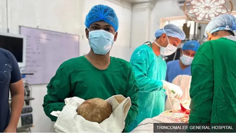 Sri Lankan Doctors Remove 3.1-Kg Bladder Stone in Rare Medical Case